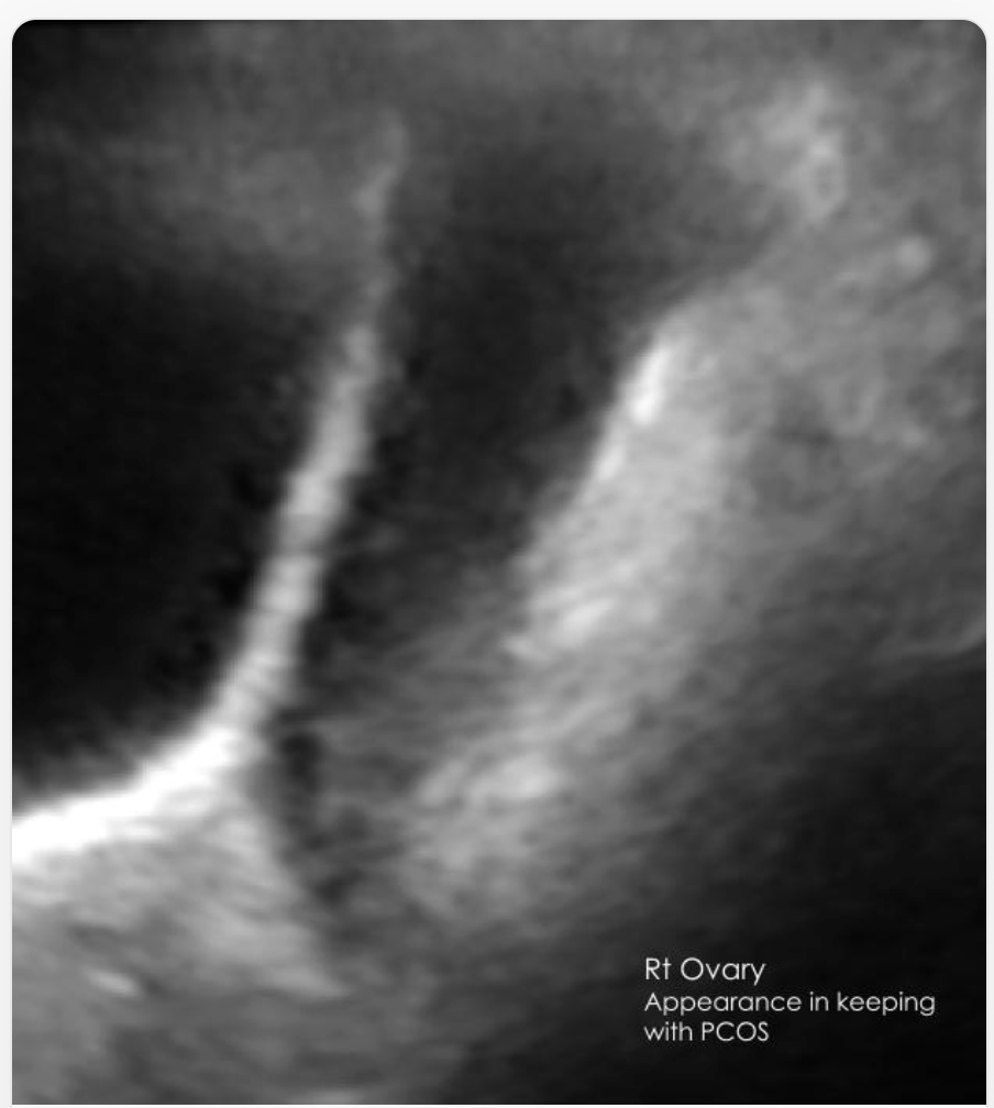 Right ovary with antral follicles ultrasound